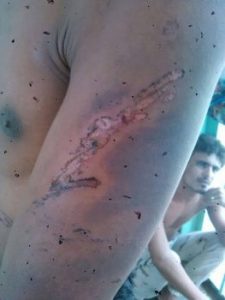 صورٌ مروعة لضحايا التعذيب في سجن المنصورة بعدن